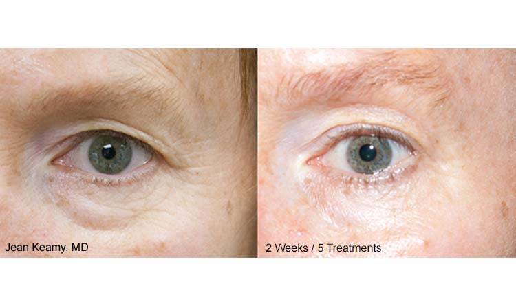 thermismooth before and after