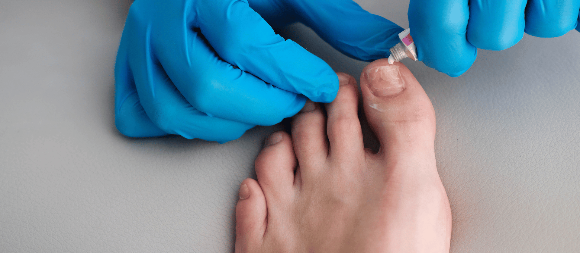 toe nail fungus