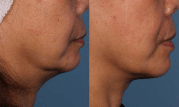 Ultherapy before and after