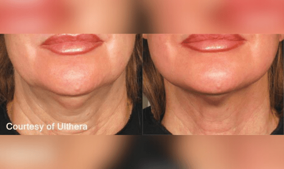 Ultherapy before and after