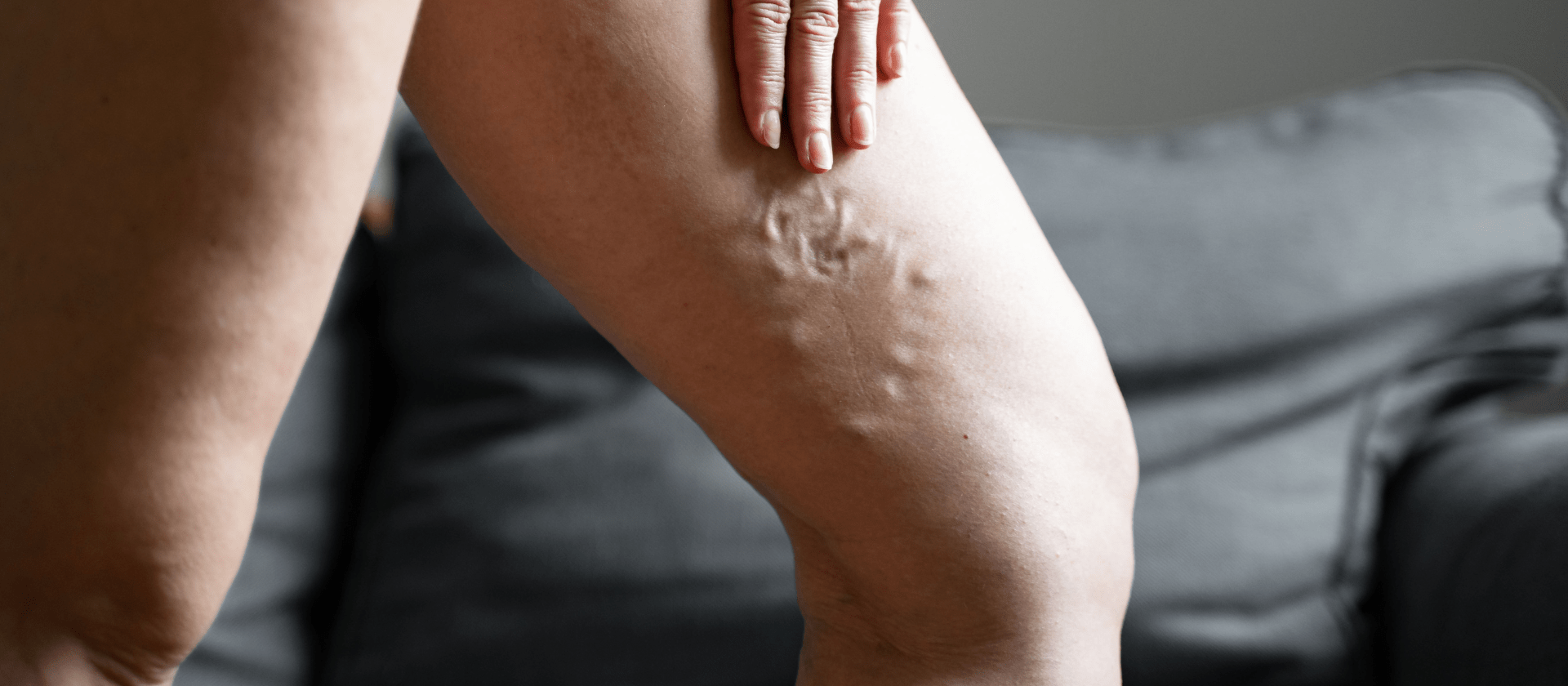 woman touching varicose veins on inner thigh