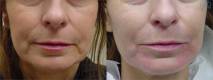 Before and After Nose to Mouth Lines Treatment 4