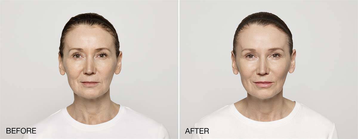 Restylane Lift Before and After Image 2