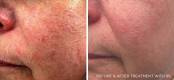 Before and After Enlarged Blood Vessels Treatment 3