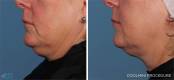 CoolSculpting Before and After Image 19