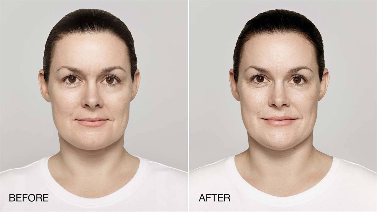 Restylane Lift Before and After Image 1