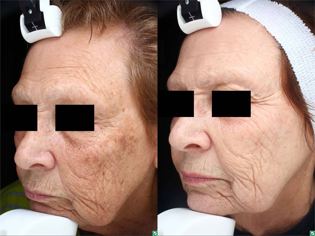 PicoSure Before and After 3