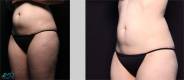 CoolSculpting Before and After Image 8