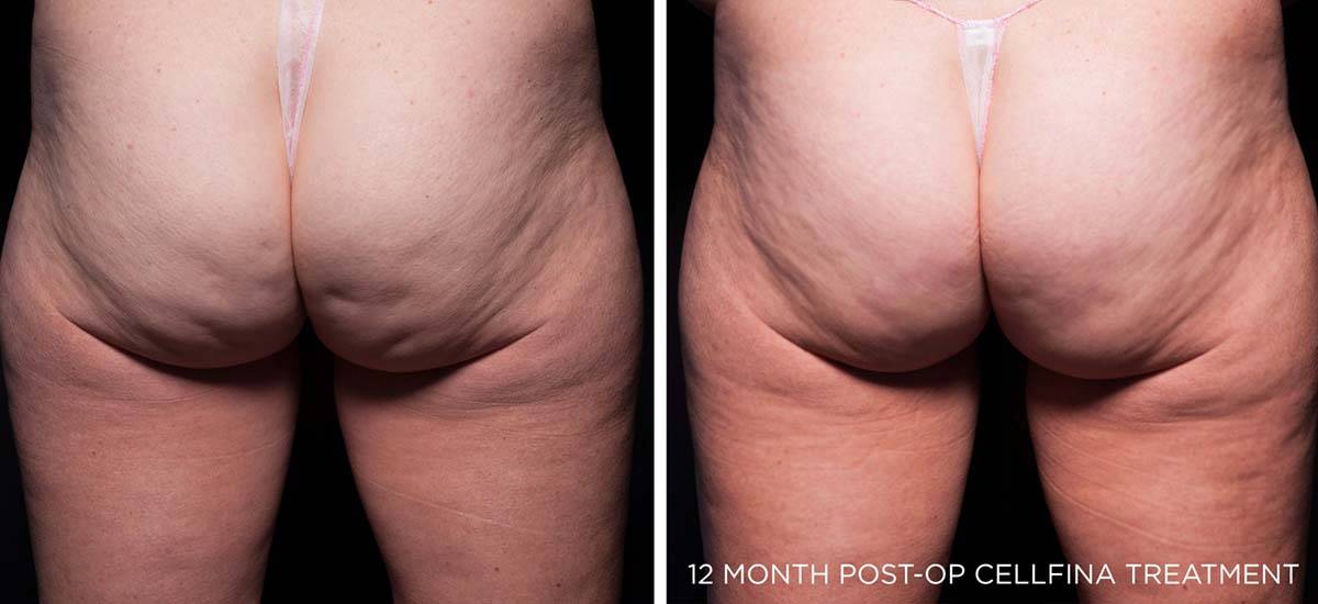 Before and After Cellulite Treatment 1