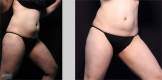 CoolSculpting Before and After Image 9