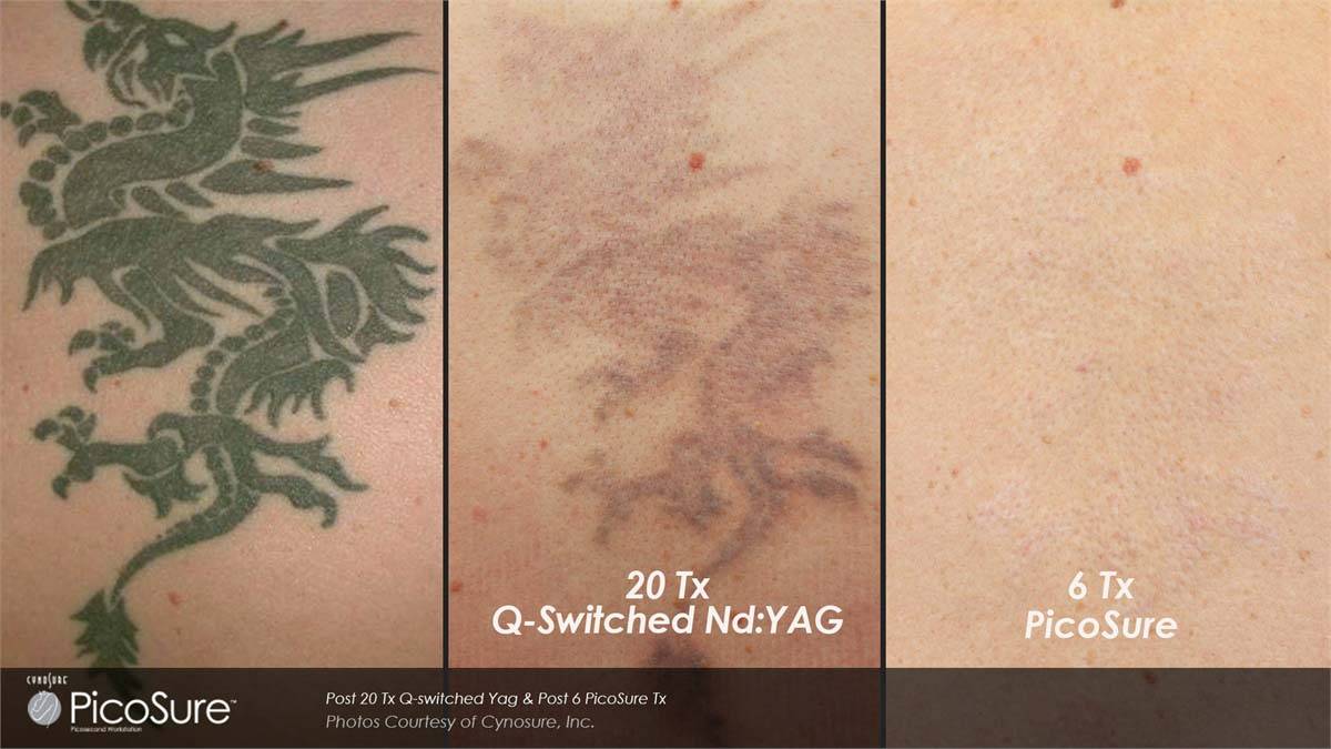 PicoSure Tattoo Removal Before and After 4
