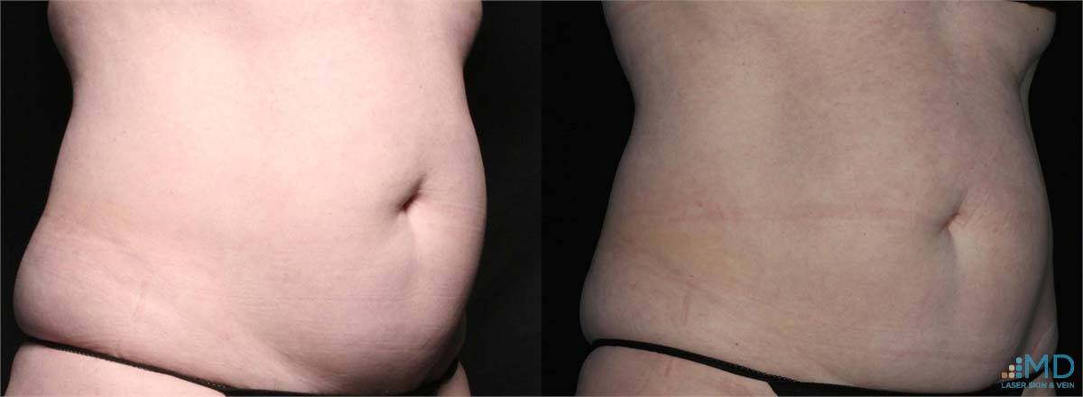 SculpSure Before and After 2