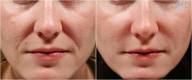 juvederm before and after image 3