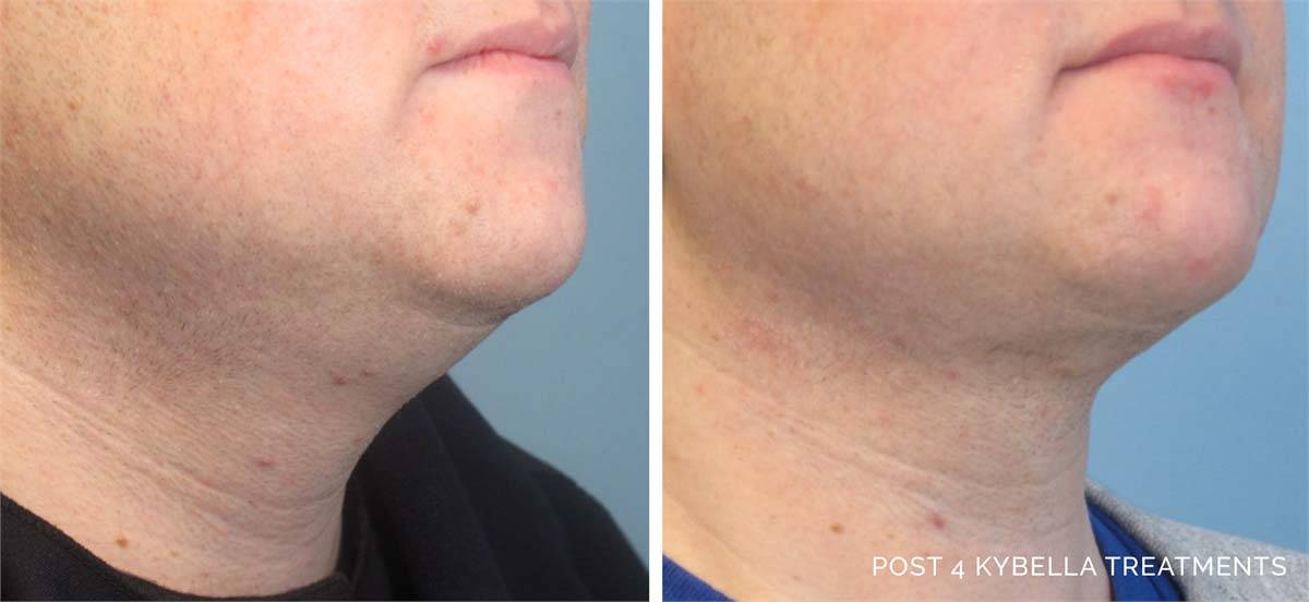 Kybella Before and After 6