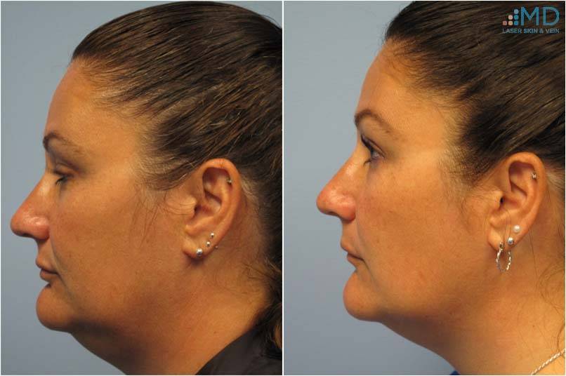 Before and After Unwanted Fat Treatment 2