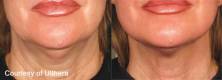Before and After Sagging Skin Treatment 6