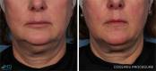 CoolSculpting Before and After Image 17