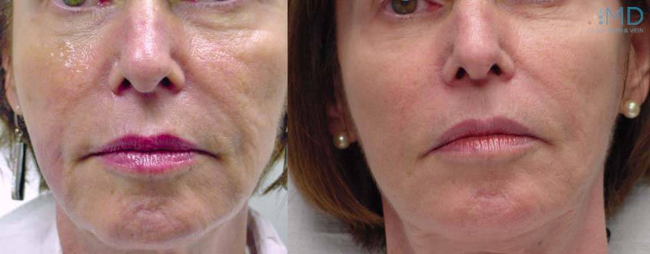 Exilis before and after 2