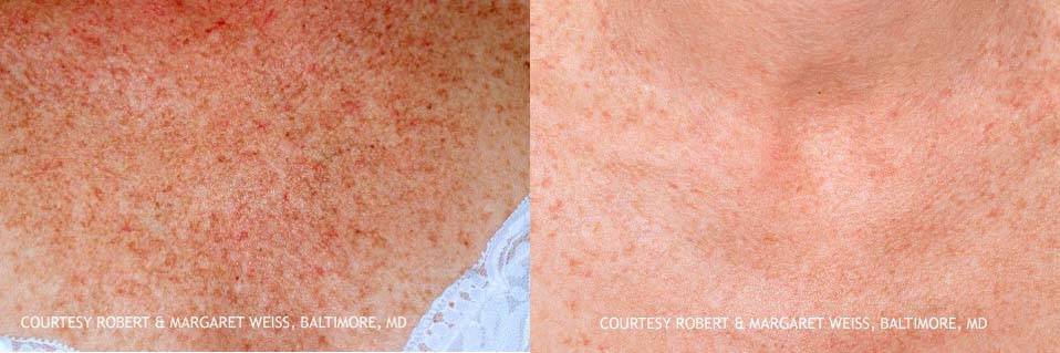 Freckles and Blotchy Pigment Before and After 6