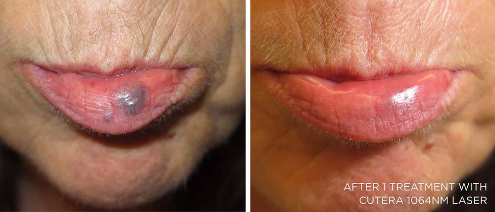 Before and After Enlarged Blood Vessels Treatment 5