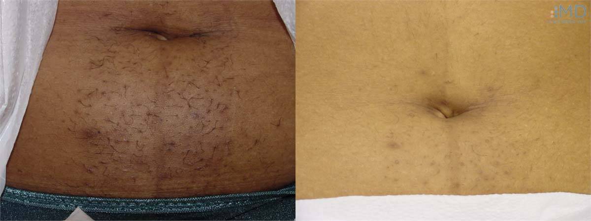 Laser Hair Removal Before and After 3