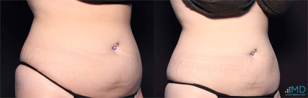 CoolSculpting Before and After Image 20
