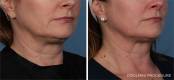CoolSculpting Before and After Image 15