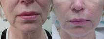 Restylane Silk Lips Before and After Image 1