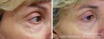 Before and After Enlarged Blood Vessels Treatment 2