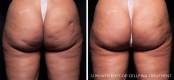 Before and After Cellulite Treatment 2