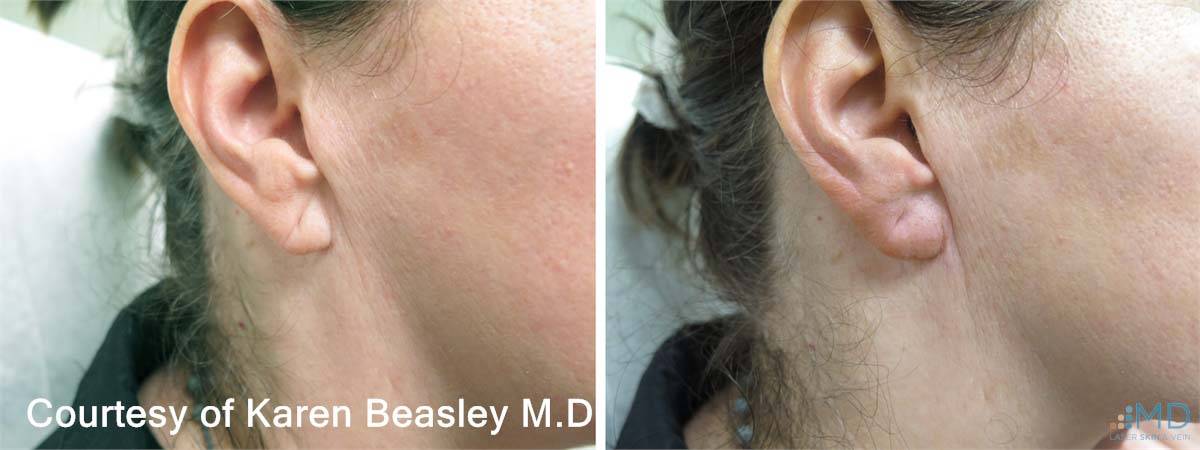 Earlobe rejuvenation Before and After 1