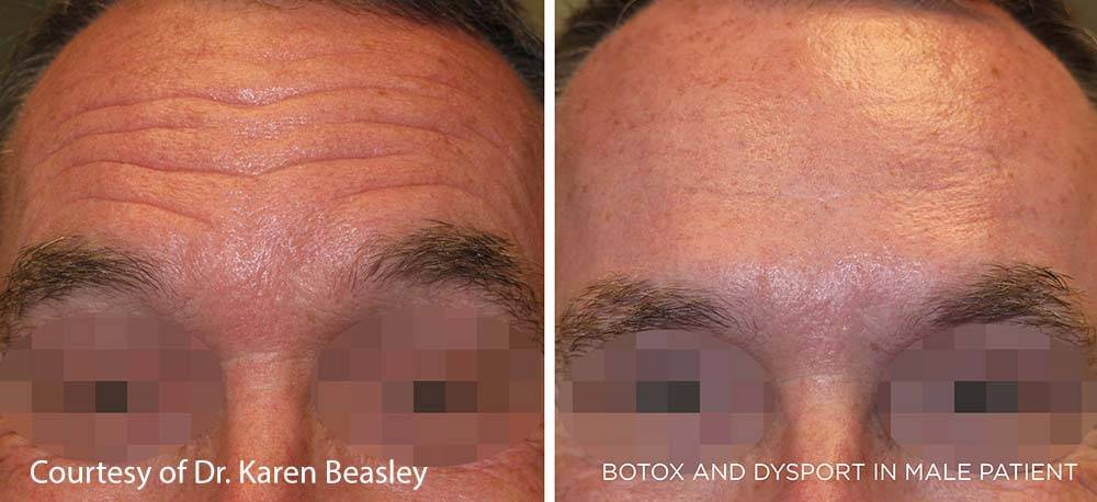Botox Dysport Before and After Image