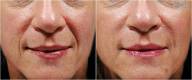 Before and After Nose to Mouth Lines Treatment 1