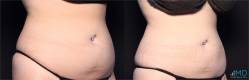 CoolSculpting Before and After Image 20