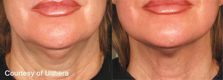 Ultherapy Before and After 3