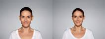 Restylane Defyne Before and After Image 1