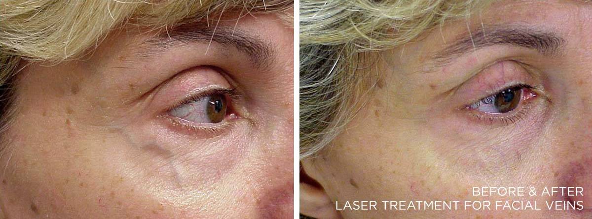 Before and After Enlarged Blood Vessels Treatment 2
