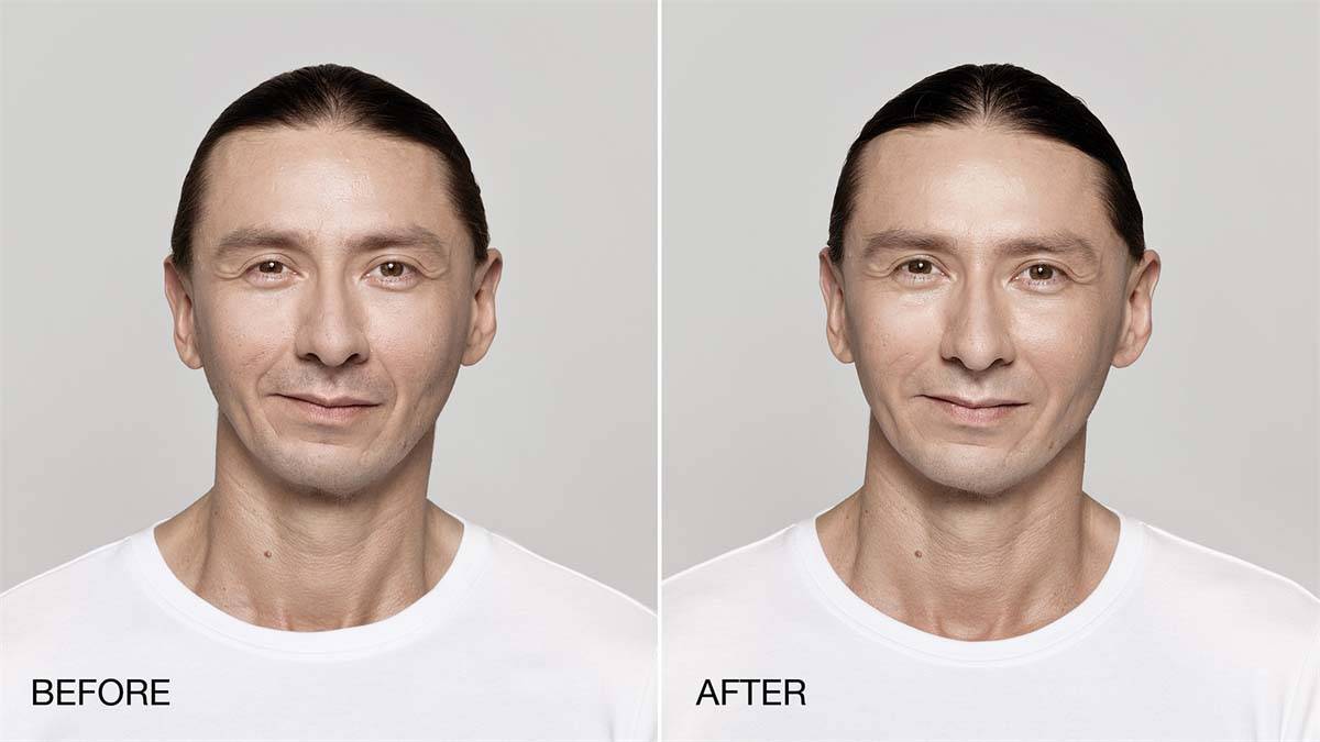 Restylane Lift Before and After Image 4