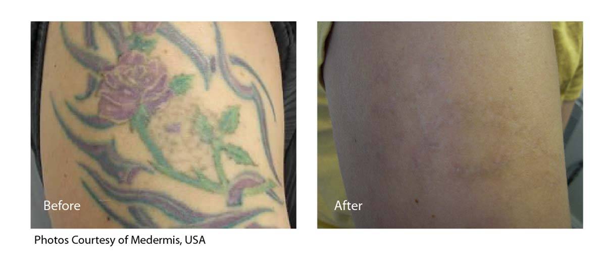 PicoSure Tattoo Removal Before and After 6