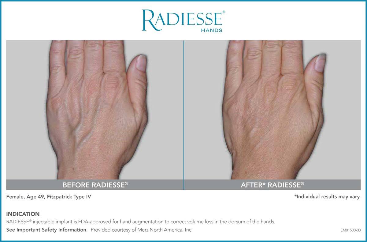 Radiesse Before and After 2