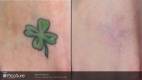 PicoSure Tattoo Removal Before and After 5