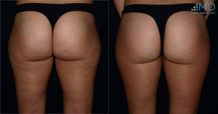 Before and After Unwanted Fat Treatment 1