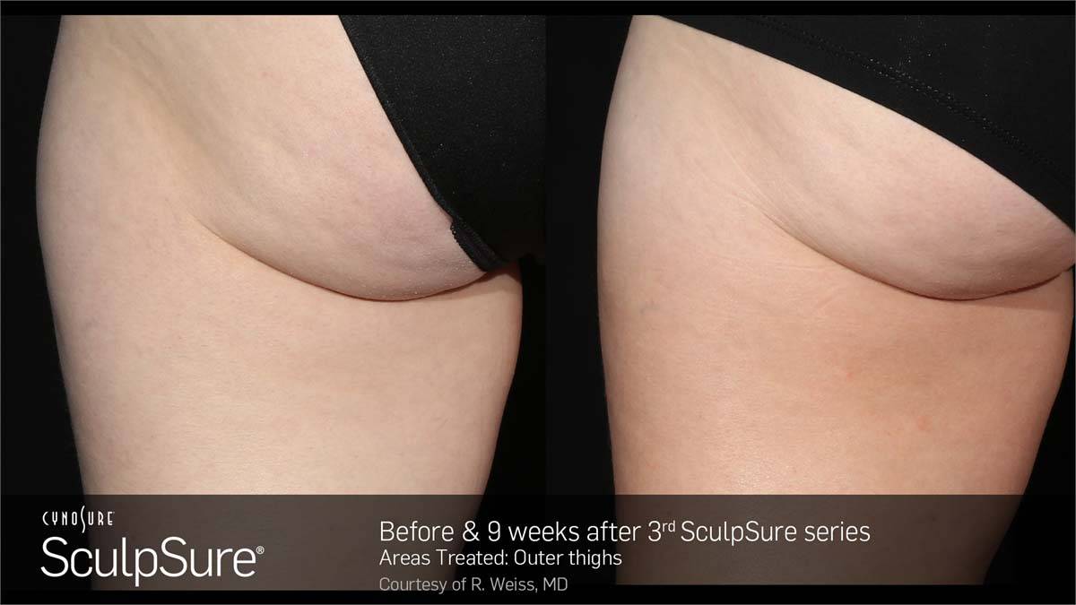 SculpSure Before and After 1