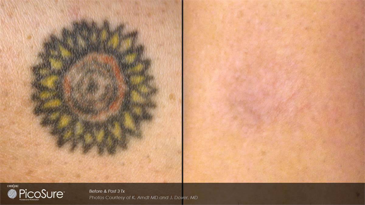PicoSure Tattoo Removal Before and After 1