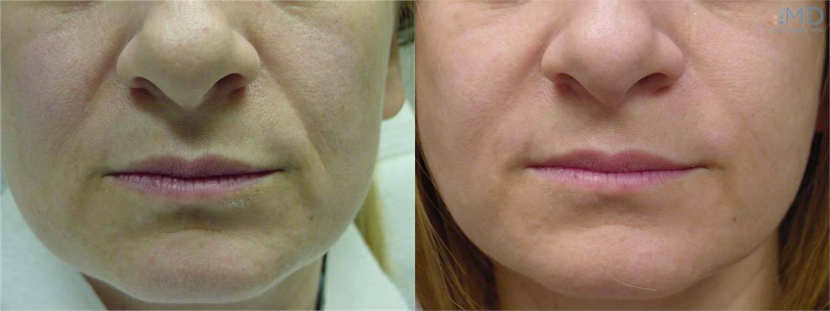 Before and After Nose to Mouth Lines Treatment 3