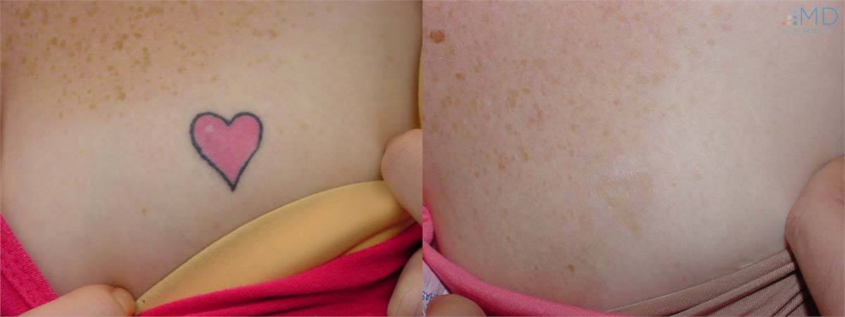PicoSure Tattoo Removal Before and After 7