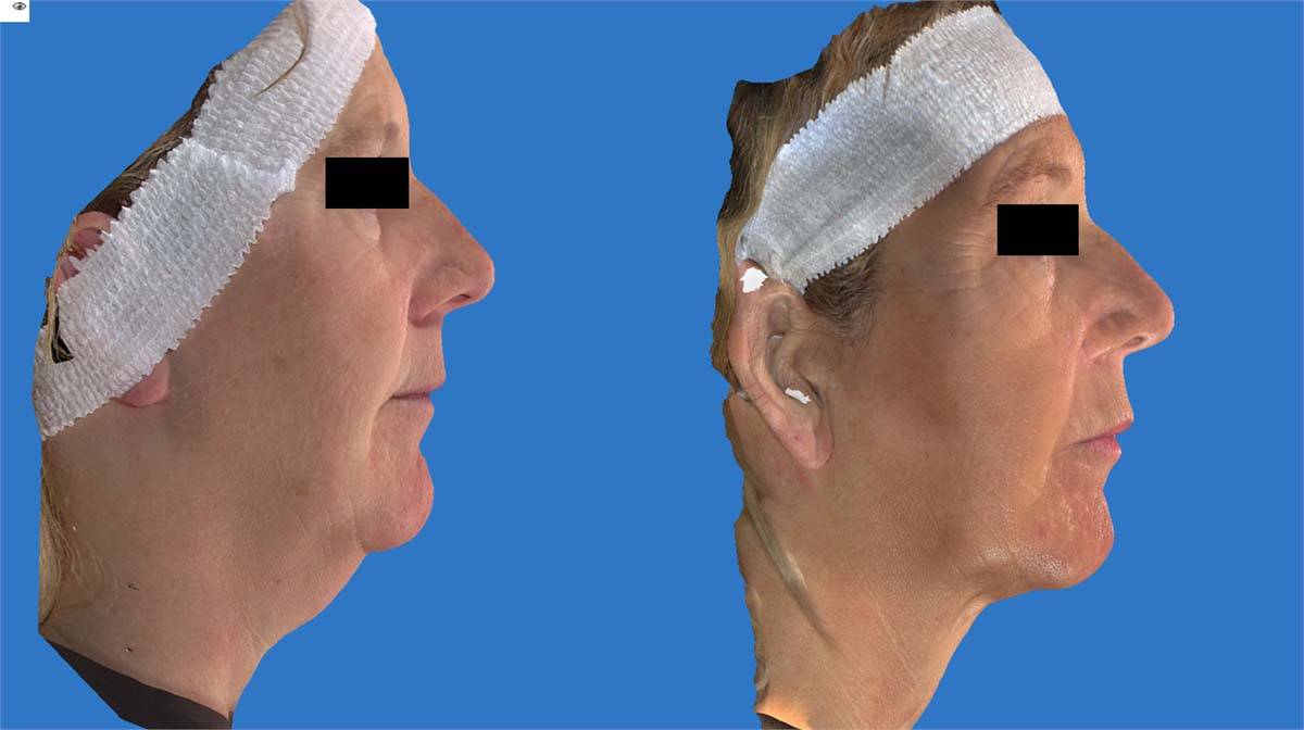 Kybella Before and After 1