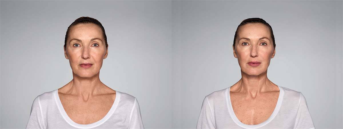 Restylane Defyne Before and After Image 3