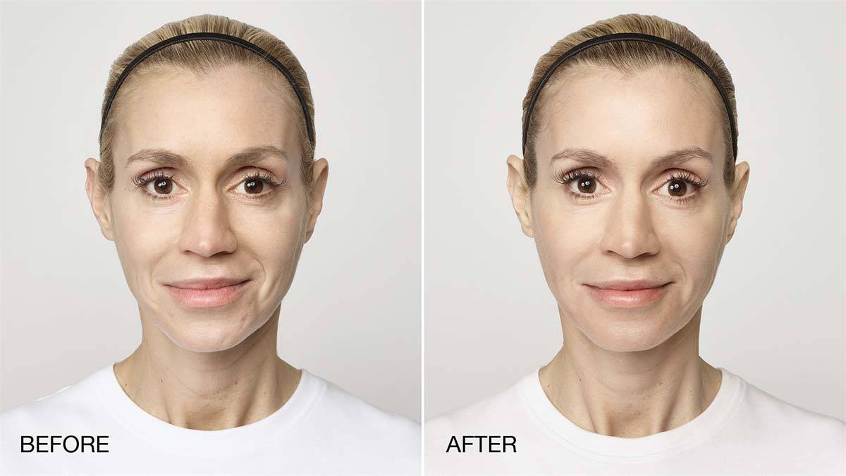Restylane Silk Before and After Image 2