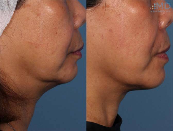 Ultherapy Before and After Image
